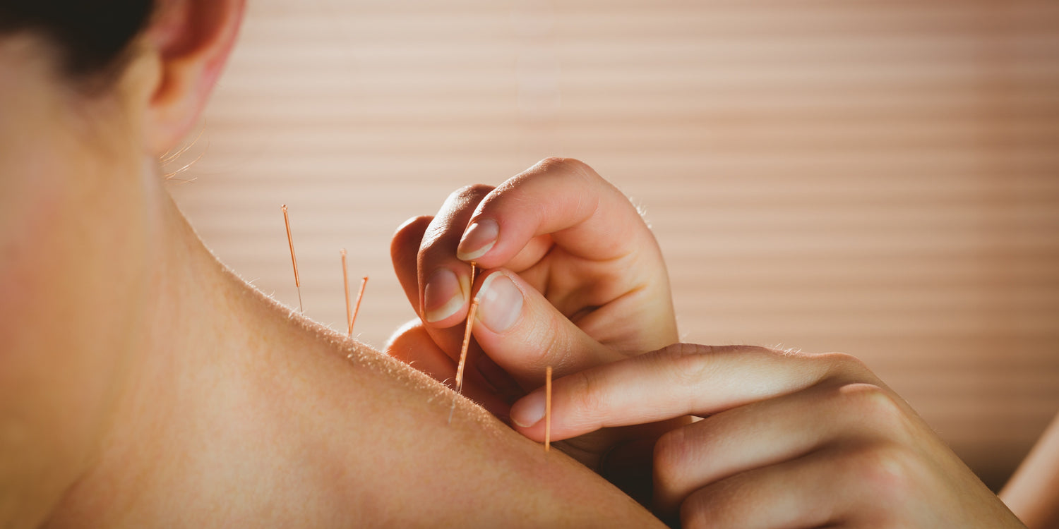 Deliberately Minimal: Acupuncture 101 - From Pregnancy to…Everything Else